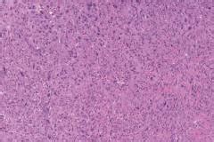 Atypical fibroxanthoma | Atlas of Pathology