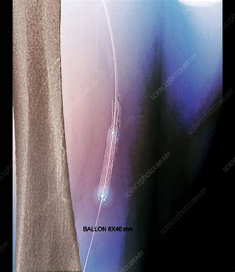 Leg artery angioplasty, angiogram - Stock Image - C048/9313 - Science Photo Library