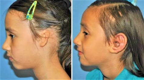 Microtia ear causes, disgnosis & microtia treatment