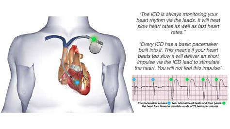 Icd Vs Pacemaker - :: Dr. Swapan Kumar De :: Cardiac Device Implantation ... / It is so deadly ...