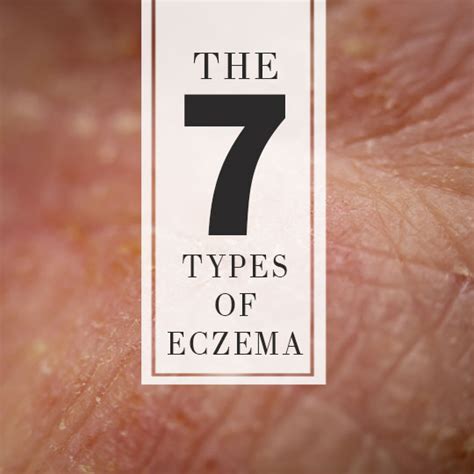 7 Types Of Eczema