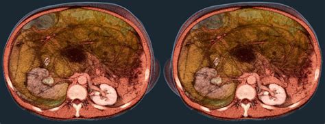 Abdominal Liposarcoma | Volume Rendering of an abdominal CT … | Flickr