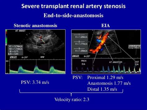 Renal Artery Stenosis Protocol Ultrasound