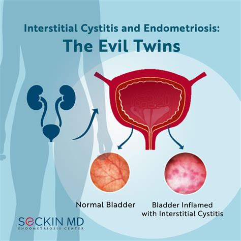 Interstitial Cystitis and Endometriosis: The Evil Twins