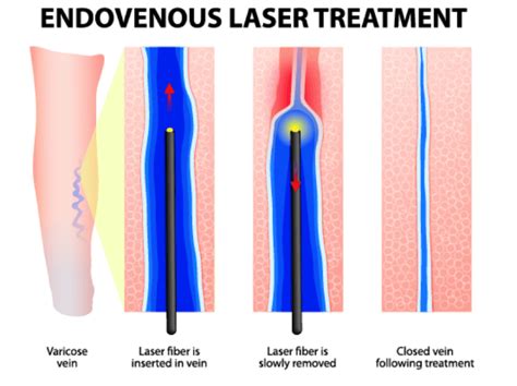 Varicose Veins Laser Treatment - Miami Vein Center