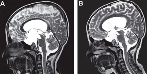 T2W-sagittal MRI of a 12-month-old boy included in this study. (A)... | Download Scientific Diagram