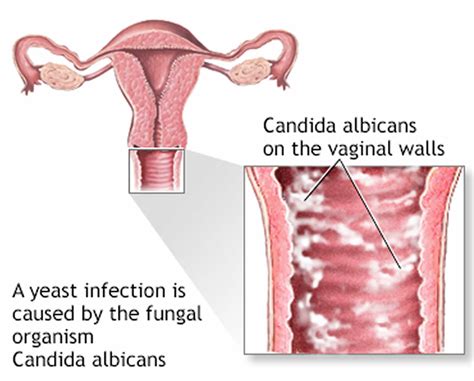 Vaginal yeast infection, causes, symptoms, diagnosis, treatment & prognosis