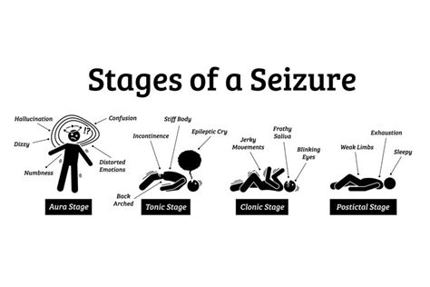 Stages and Phases of a Seizure Aura Tonic Clonic Postictal