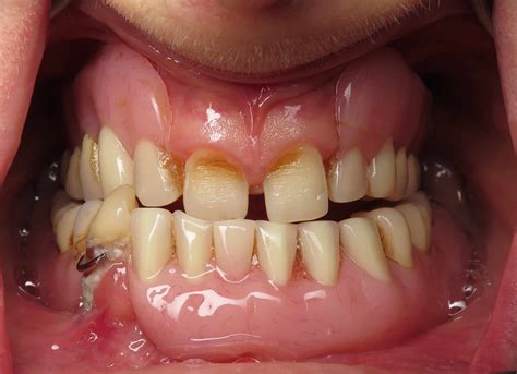 Temporary Full Implant Teeth. Why Do This Step? | Ramsey Amin, DDS