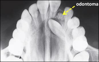 Etiology of maxillary canine impaction: A review | Pocket Dentistry