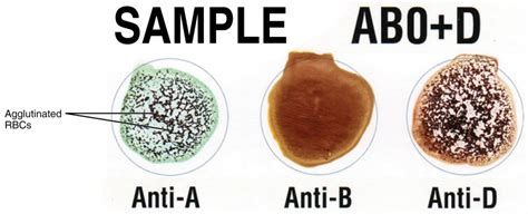 Blood Typing | Anatomy and Physiology II