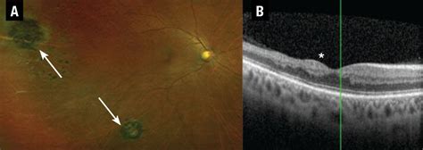 Sickle cell retinopathy: An update on management