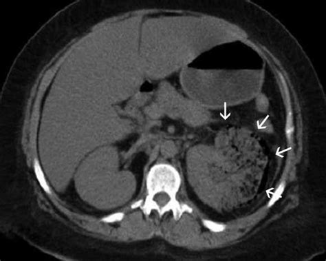 Emphysematous pyelonephritis | Medical journals, Pet ct, Clinical research