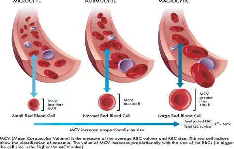 Microcytic (Hypochromic) Anemia: Symptoms, Causes and Treatment