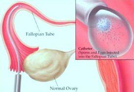 Infertility Guide: What Is Gamete Intrafallopian Tube Transfer?