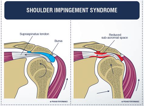 Shoulder Impingement Syndrome | Full Function Rehab