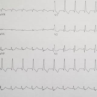 Accelerated junctional rhythm with retrograde conduction, incomplete... | Download Scientific ...