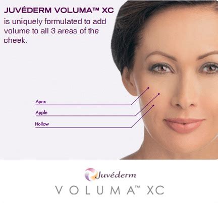 How Much Does Juvederm VOLUMA Cost? Glendale | Pasadena | Burbank CA