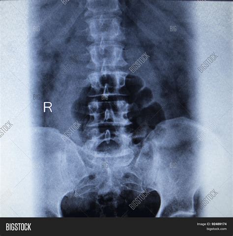 X-ray Orthopedics Image & Photo (Free Trial) | Bigstock