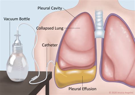 Indwelling Pleural Catheter (PleurX™) | OncoLink