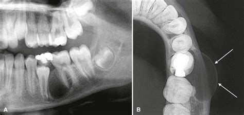 Radicular Cyst Radiograph