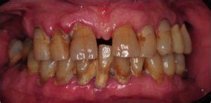 chronic periodontitis advanced periodontal disease | chronic periodontitis advanced periodontal ...