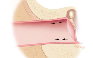 Exostoses of the Ear Canal – Oto Surgery Atlas