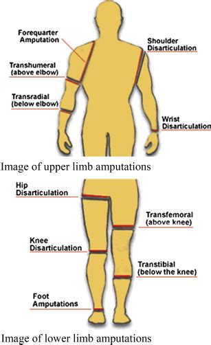 Ideal Functional Outcomes for Amputation Levels | Musculoskeletal Key