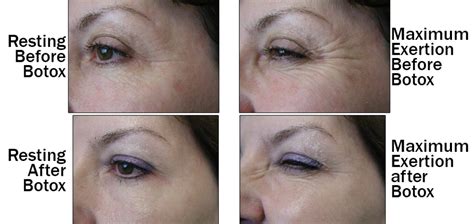 Botox for Wrinkles | Baylor Medicine