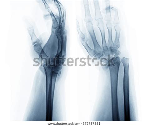 Xray Photos Hand Bone Fracture Patients Stock Photo 372787351 ...