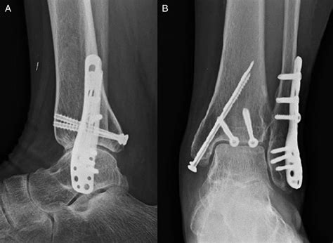 Single Oblique Posterolateral Approach for Open Reduction and Internal Fixation of Posterior ...