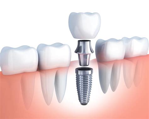 Dental Implant Procedure: Everything You Need To Know