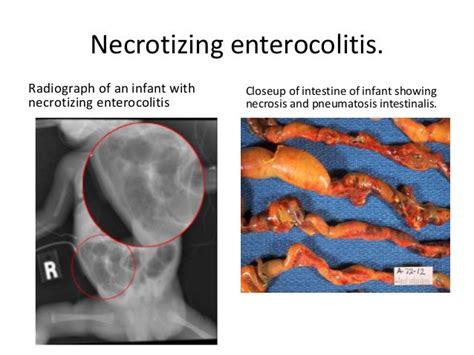 Pin by george k on "Necrotizing Enterocolitis" | Radiographer, Intestines