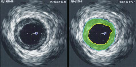 Intravascular ultrasound - wikidoc