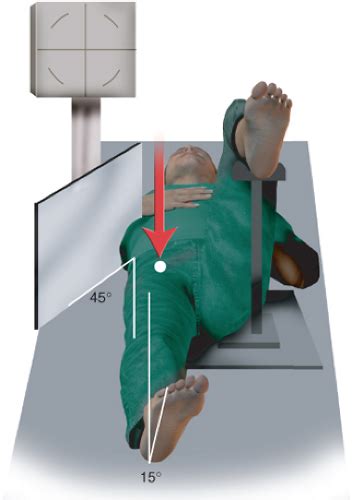 Radiographic Evaluation of the Hip | Musculoskeletal Key