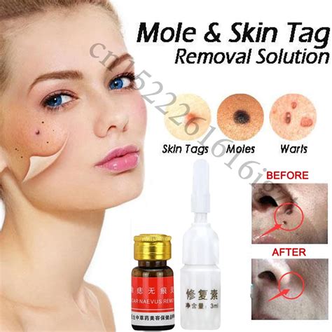 Mole & Skin Tag Removal Solution Painless Mole Skin Dark Spot Removal Face Wart Tag Freckle ...