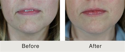 Mole Removal Before and After | Carolina Facial Plastics