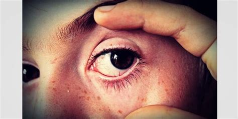 Causes of Eye Flu | Eye Flu Prevention | How Can I Control My Eye Flu?