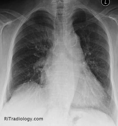 RiT radiology: Sternal Osteomyelitis