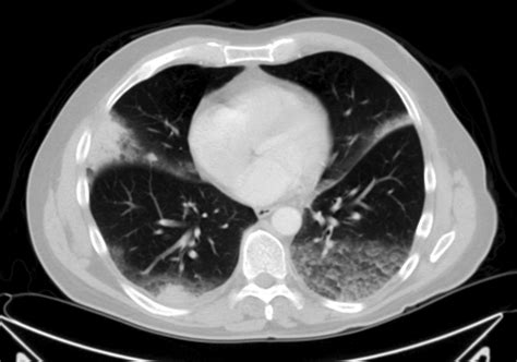 Bronquiolite Obliterante Organizador de Pneumonia/Criptogénica ...