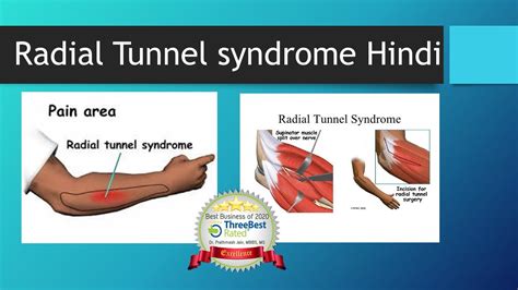 Radial tunnel syndrome Hindi - YouTube