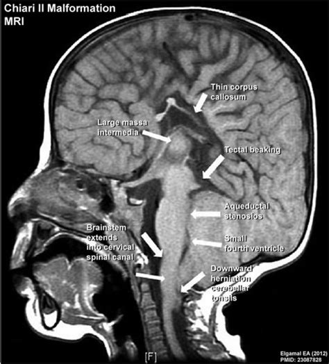 File:Chiari II malformation MRI02.jpg - Embryology