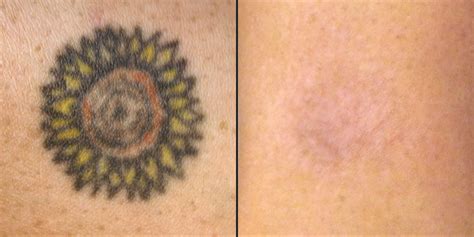 Natural Tattoo Removal: How To Remove Tattoos Naturally?