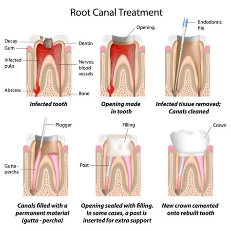 Pulp Canal