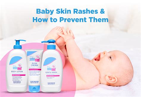 Baby’s Skin Rash – Causes, Treatment & Prevention Tips - FirstCry Parenting