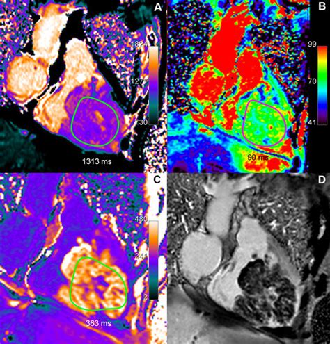 Renal cell carcinoma metastasis: Huge right ventricular metastasis of a... | Download Scientific ...