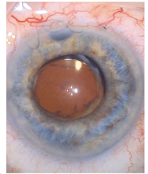 Still taken during IOL removal | Download Scientific Diagram