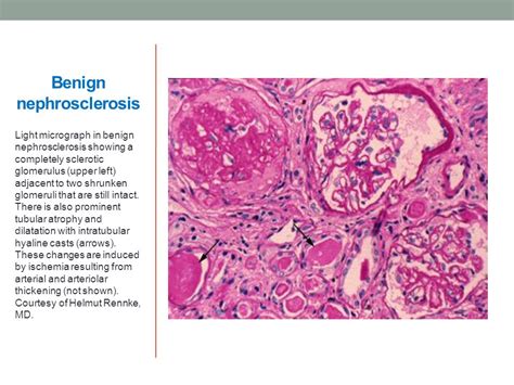 Hypertensive Nephrosclerosis Kidney Histology, 40% OFF