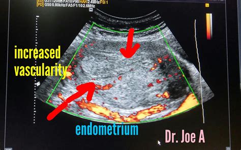 Ultrasound imaging: Cystic-endometrial-hyperplasia-3D ultrasound