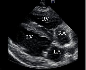 Pulmonary Hypertension